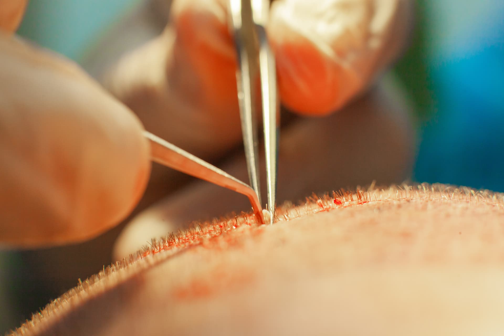 Slim FUE Hair Transplant