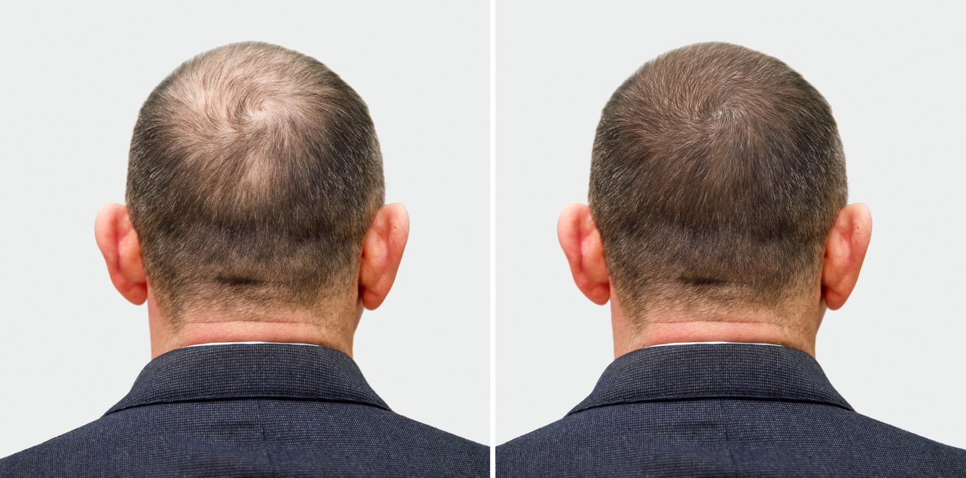 What to Expect After the Invisigraft Transplant