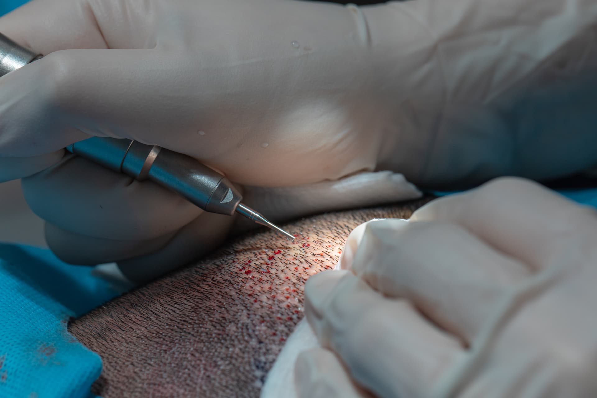 What Makes Slim FUE Different?