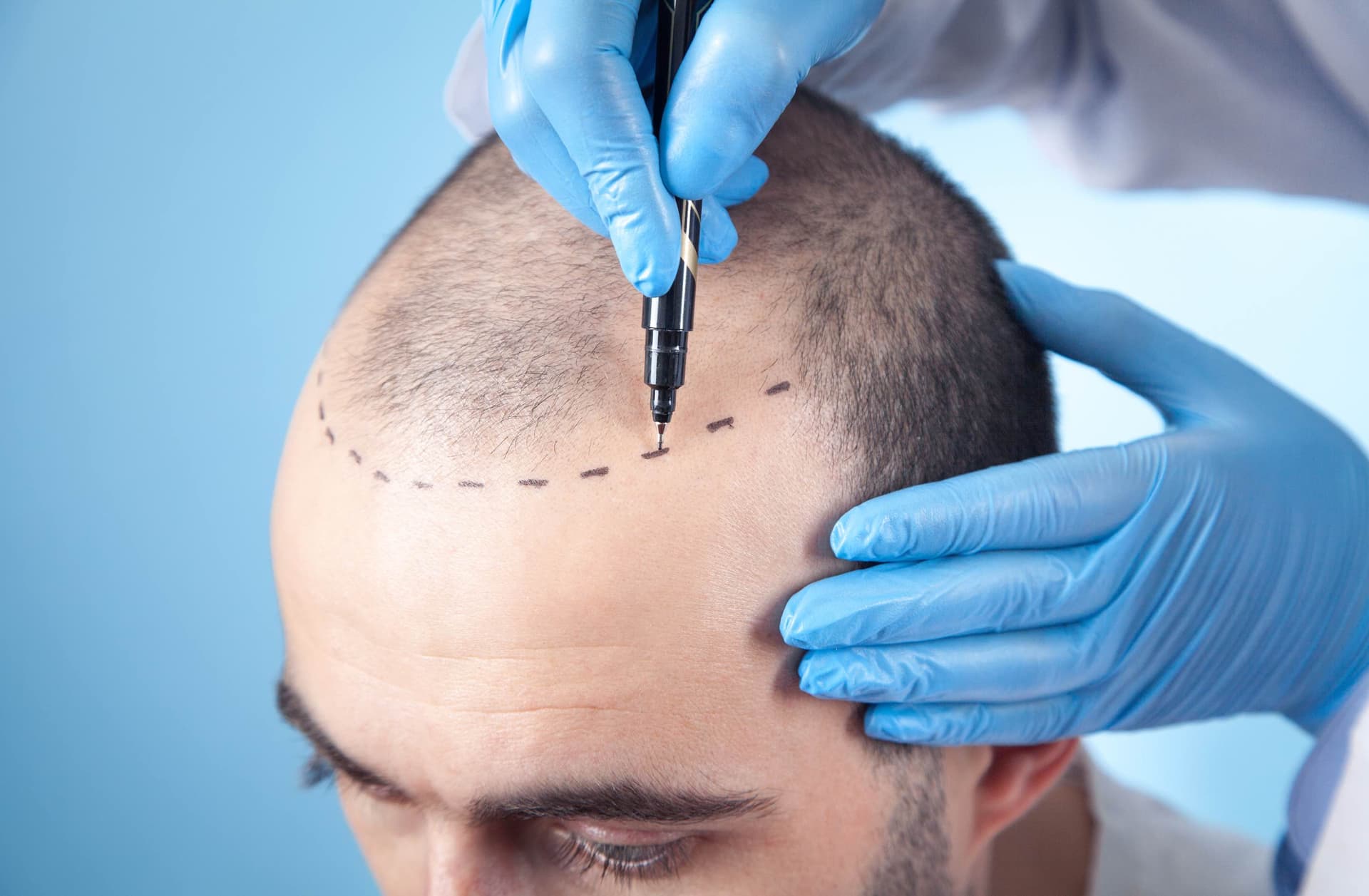 The Benefits of Slim FUE