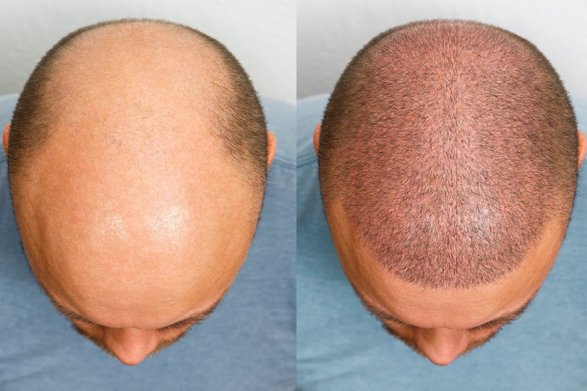 What to Expect from the Slim FUE Process