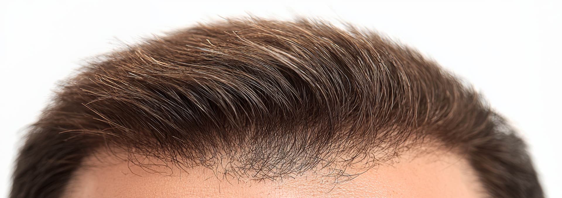 Is Slim FUE Right for You?