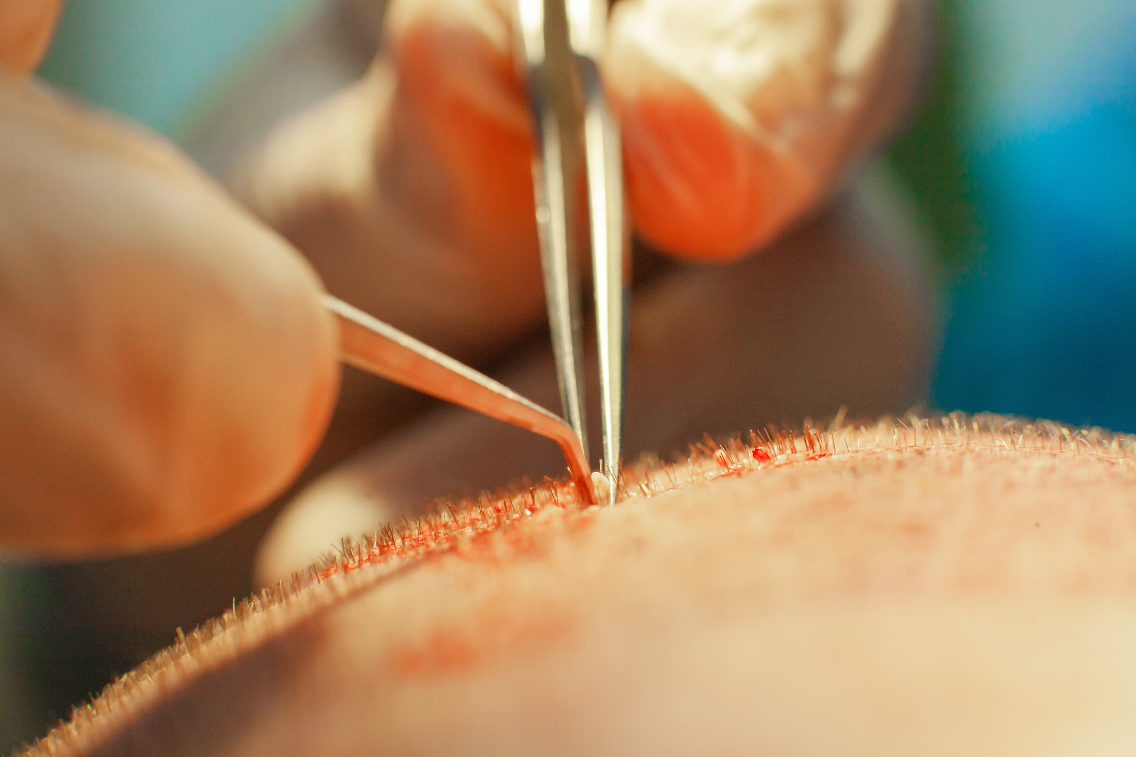 Slim FUE Hair Transplant