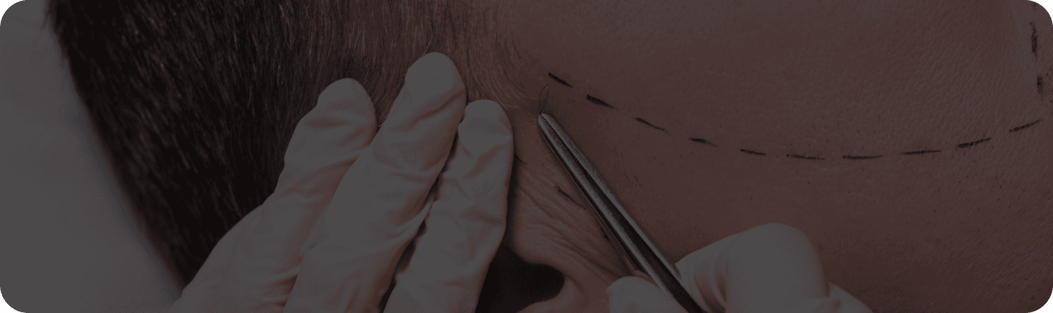 Beardcraft Transplant