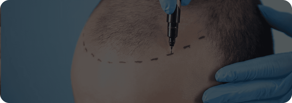 Invisigraft Hair Transplant