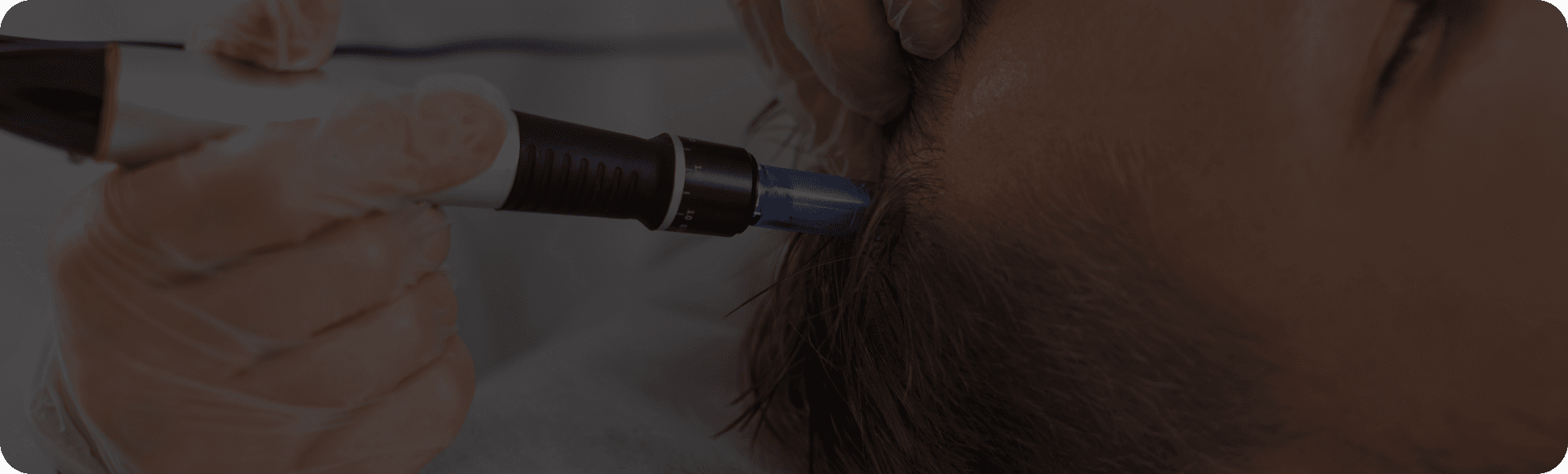 Scalp Microneedling